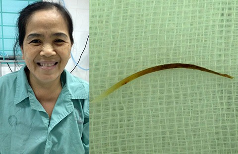 Hóc xương cá năm tháng mới phát hiện