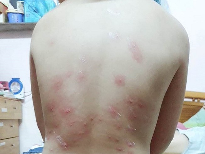 Lấy mẫu truy nguyên nhân ngứa khi tắm biển Đà Nẵng