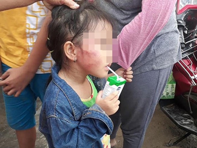 Bình Chánh: Cô giáo đánh trẻ nứt xương hàm