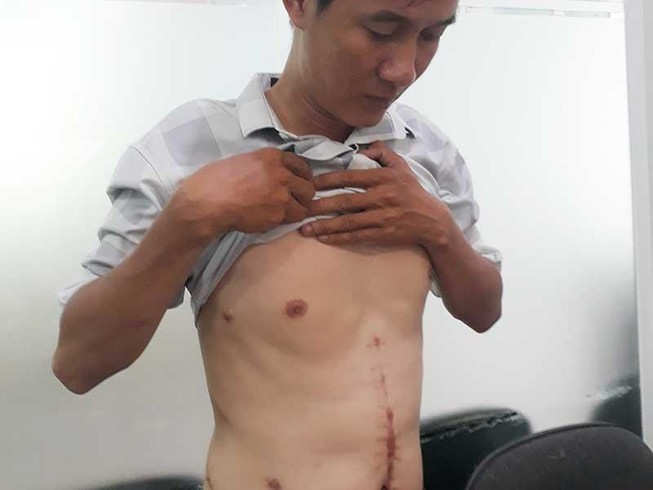 Bị thương tích nặng khi ngăn người khác đánh nhau