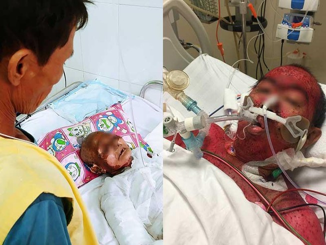Suy thận nặng, hoại tử sau khi uống thuốc cảm sốt