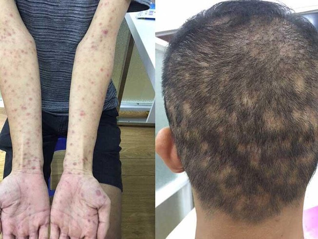 Báo động bệnh giang mai tăng cao, trẻ hóa
