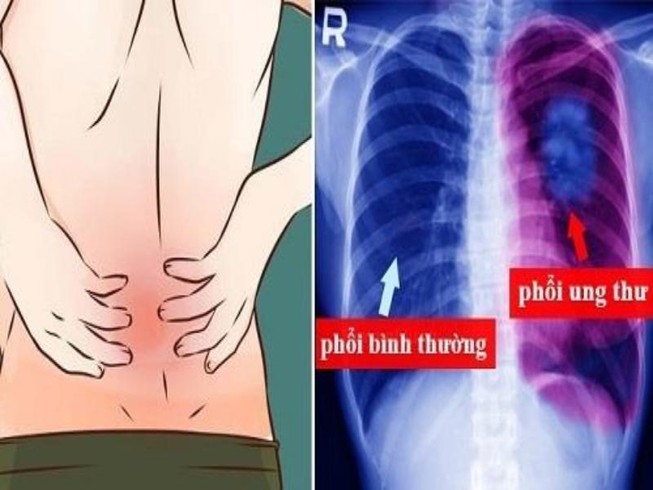 Ðau lưng phía sau phổi có phải dấu hiệu ung thư?