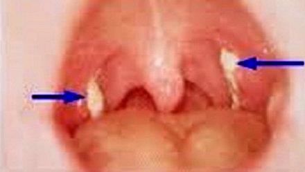 1 em bé tử vong do bị bệnh bạch hầu, nhiều người lây nhiễm