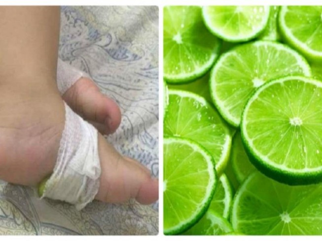 Sốt co giật, vắt chanh vào miệng, bé lập tức tím tái