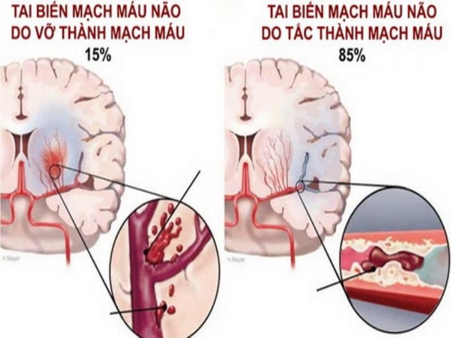 Tai biến mạch máu não: Cấp cứu thế nào để tránh tử vong?