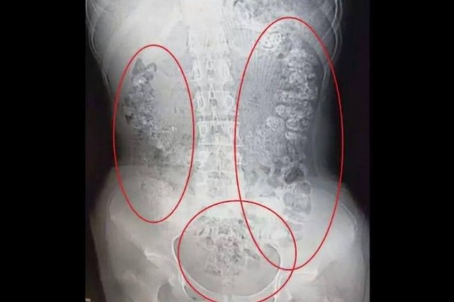 Không thể tìm ra nguyên nhân gây ra vấn đề tiêu hóa của cô, CT scan đã được thực hiện, trong đó các bác sĩ tìm thấy nhiều bóng hình cầu bất thường trong bụng cô. Ảnh: WEIBO