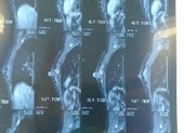 Bị ung thư, cô gái trẻ sốc vì phải cắt toàn bộ tuyến vú