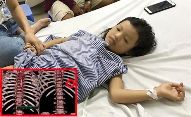 Bé 7 tuổi bị đạn lạc xuyên thấu ngực
