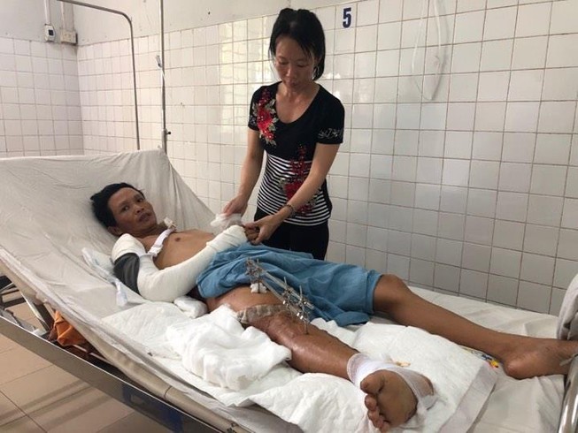 Tai nạn kinh hoàng khiến nam công nhân đứt lìa đùi phải