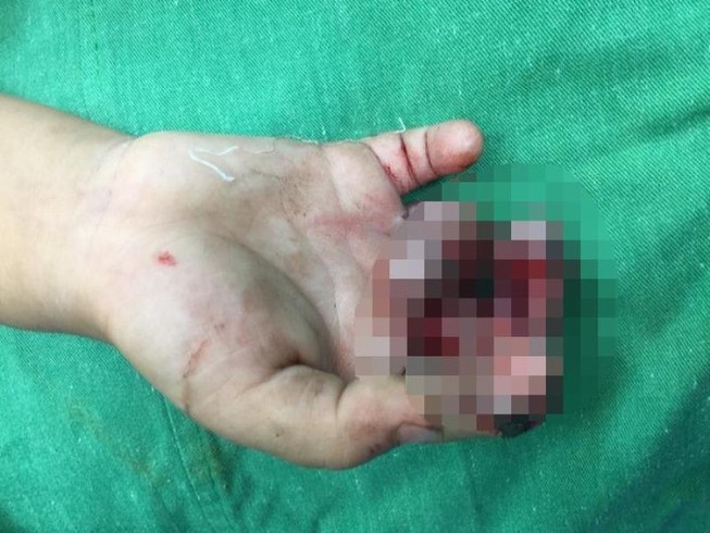 Nghịch dại, bé 4 tuổi cho tay vào máy ép nước mía