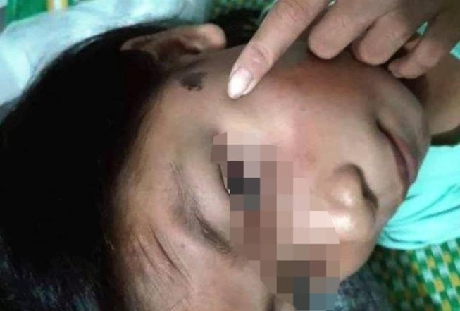 Công an viên tra khảo bé gái 12 tuổi bầm tím mông