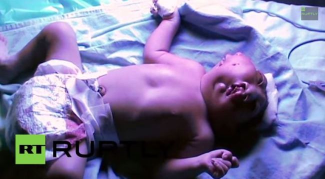 Em bé sơ sinh có hai khuôn mặt