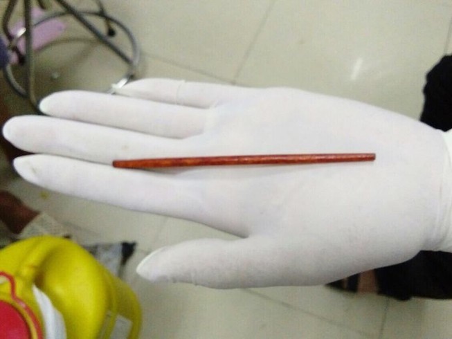 Hy hữu: Cây đũa 12 cm chui tọt vào trong niệu đạo