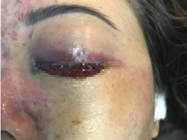 'Sờ gáy' spa làm mù mắt cô gái sau tiêm filler nâng mũi
