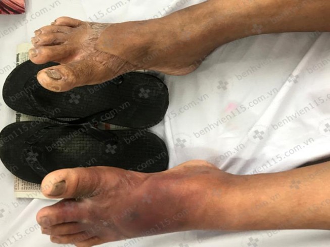 Phát hiện bị đái tháo đường nhờ… dép kẹp