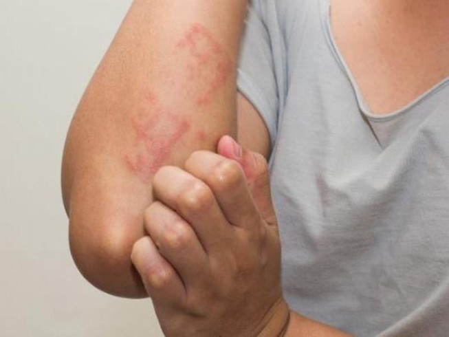 Những biểu hiện 'tố' bạn bị dị ứng thuốc