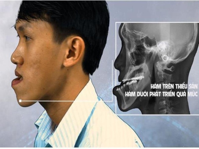 Điều trị lệch xương hàm vào chung khảo Sáng tạo TP.HCM