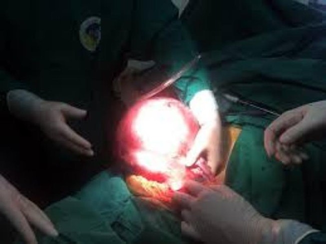 Sống cùng khối u nặng trên 6 kg suốt nhiều năm