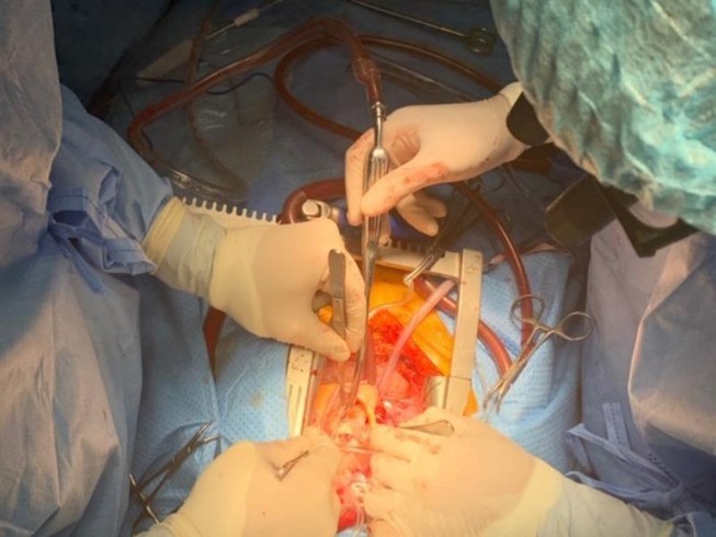 Cứu sống bệnh nhân bị u tim lớn tuổi nhất miền Tây