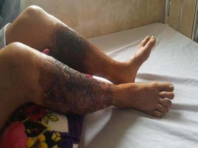 Bị bỏng nặng hai chân khi lội qua mương có chất thải độc hại