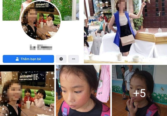 Đi học luyện chữ, bé gái 9 tuổi bị đánh bầm mặt
