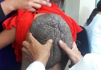Kỳ lạ cô bé 'lưng rùa' có 232 nốt ruồi trên người