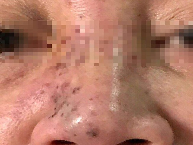 Hoại tử mặt do tiêm chất làm đầy ở Spa 'dỏm'