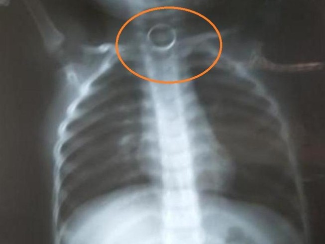 Cô giáo bất lực vì không có tiền chuyển viện cho con