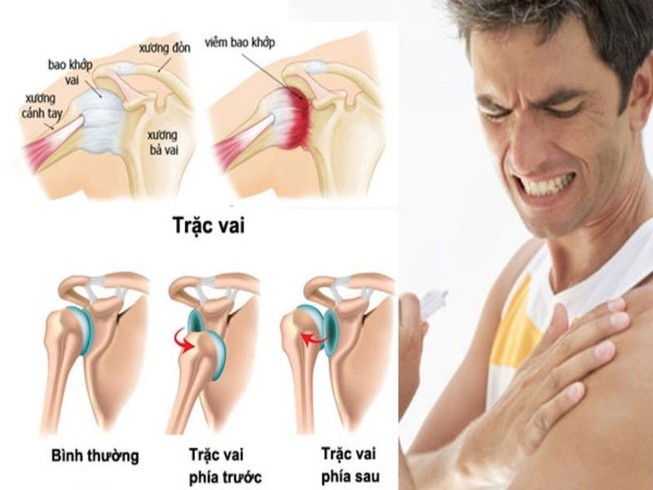 Lần đầu tiên thay khớp vai cứu thầy giáo bị u xương hiếm gặp