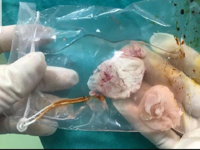 Mổ lấy ổ sán khổng lồ trong não người thích ăn tiết canh