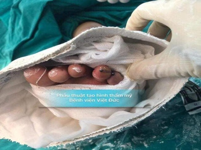 Trả lại 2 ngón chân gần như đứt hoàn toàn cho bé 6 tuổi
