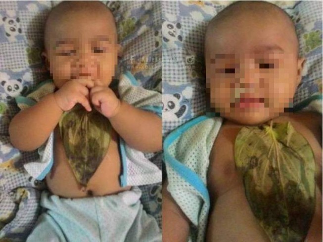 Bé gái bỏng ngực nặng vì... trị sổ mũi bằng lá trầu
