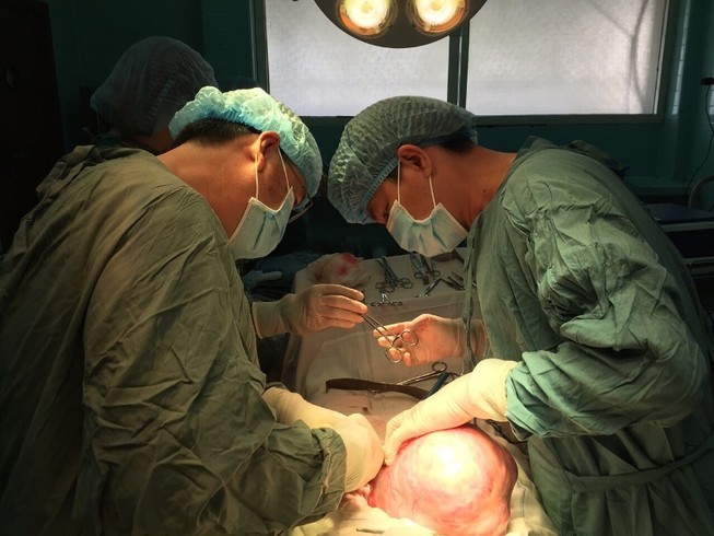 Mang khối u nặng 5 kg mà tưởng do béo bụng