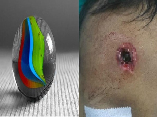 Bé trai bị đạn bị găm vào trán vì súng bắn chim cướp cò