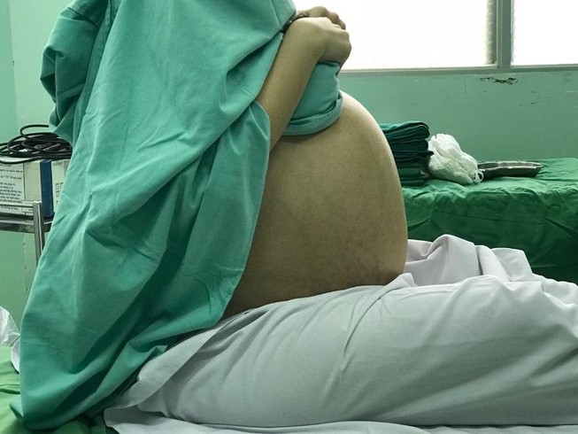 Cô gái mang khối u khổng lồ 18kg nhàm là béo bụng