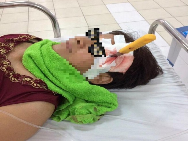 Bị dao đâm xuyên não 6 cm vì trượt chân té khi cạo vôi