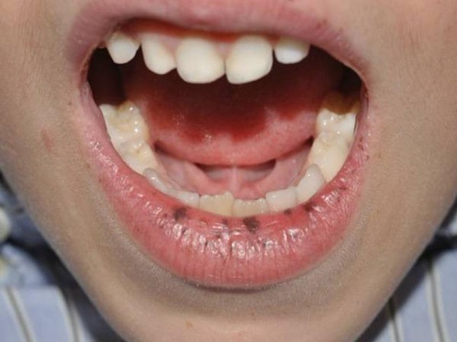 Môi có sắc tố lạ cảnh báo hội chứng dễ dẫn đến ung thư
