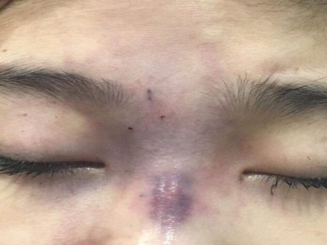 Chồng tiêm filler làm mù mắt vợ