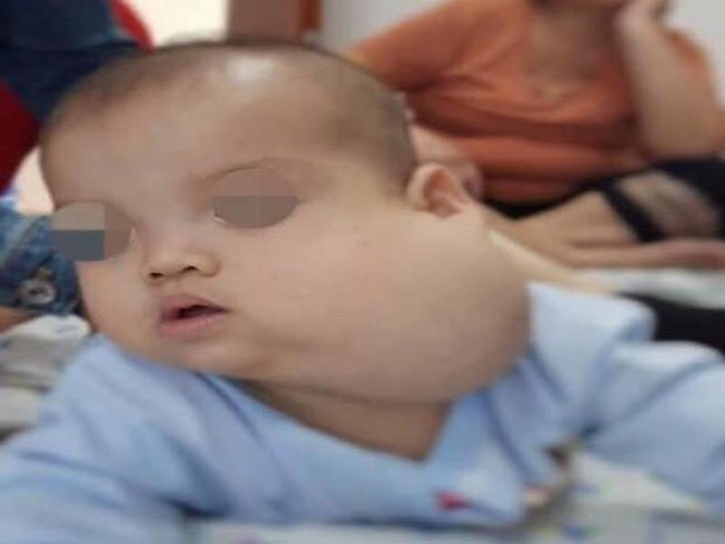 Tìm lại gương mặt cho bé trai mang khối bướu như quả bưởi