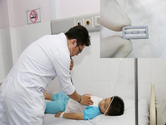 5 phút nín thở cứu bé trai nuốt nhầm đồ chơi xếp hình