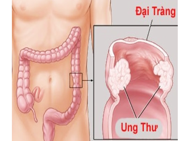 Sức khỏe, đời sống: Đừng để tử vong vì ung thư đại tràng! Ung-thu-dai-truc-trang_qulg_thumb