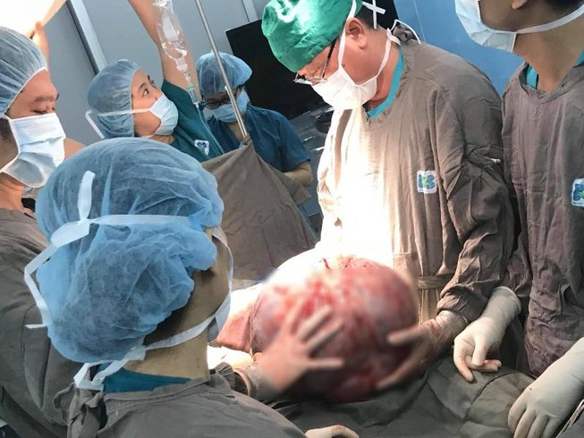 'Giải cứu' người phụ nữ mang khối u khổng lồ nặng 25 kg