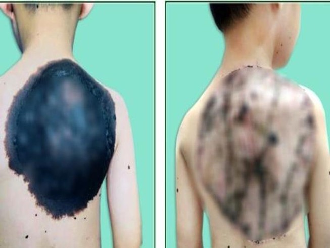 U hắc tố khổng lồ 'ăn' gần hết lưng bé trai