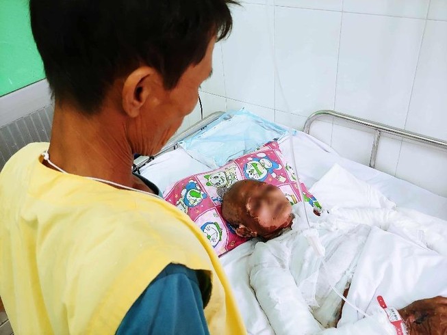 Cụ bà nổi bóng nước chảy dịch toàn thân, nghi dị ứng thuốc