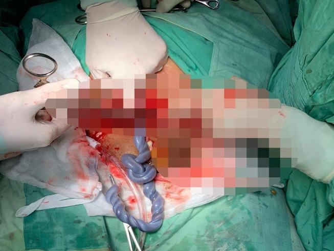 Báo động đỏ cứu bé gái thai suy vì dây rốn thắt nút