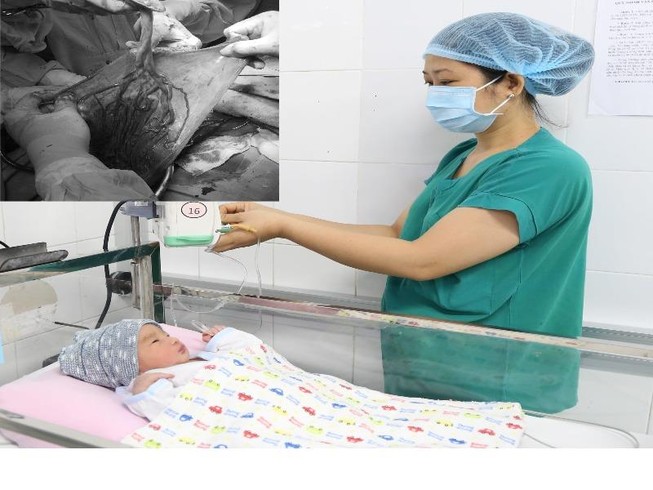 Mẹ bị dây rốn bám màng nhau suýt mất con trong tích tắc