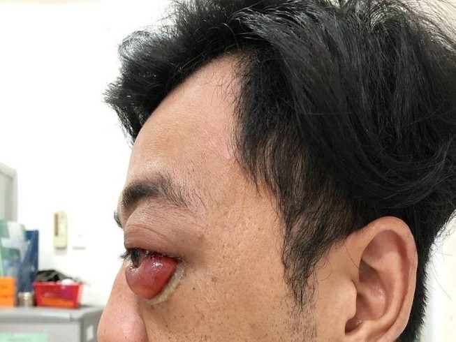 Chàng trai đột nhiên lồi mắt, suýt mù sau 2 năm bị té