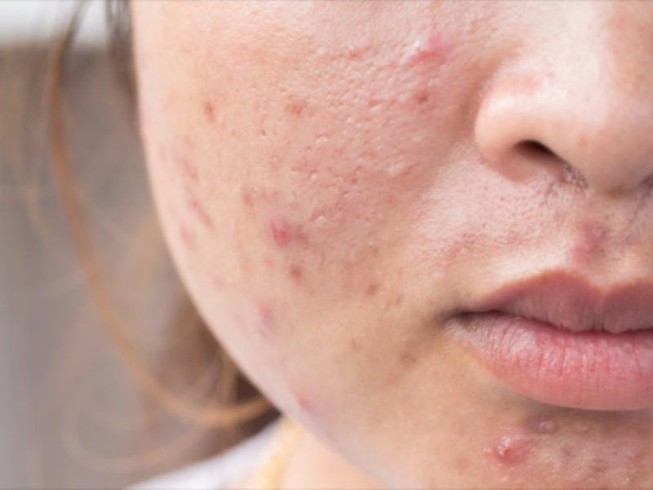 Nên hay không sử dụng kháng sinh trị mụn trứng cá