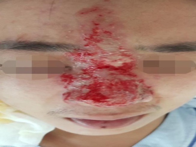 Thêm 1 người có nguy cơ mù mắt sau khi tiêm filler nâng mũi